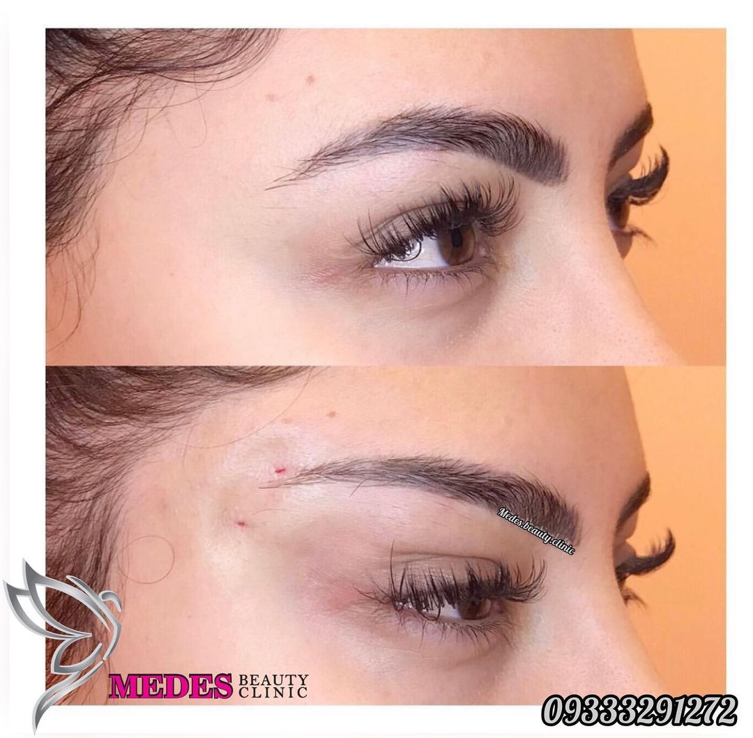 گالری لیفت با نخ